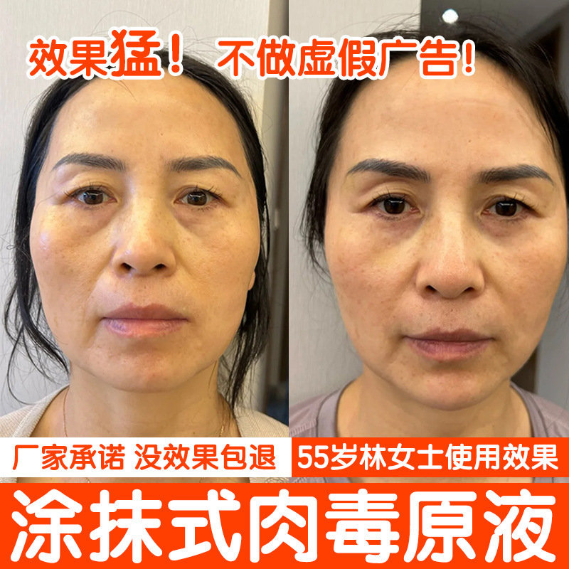 ほうれい線・額のしわ・小じわを除去する塗布型ボツリヌス原液 ボツリヌス・リフト・シワ取り・ボツリヌス・ファーミング・アンチリンクルエッセンス|undefined