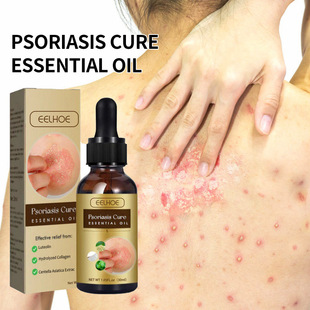EELHOE Skin Moss Repair Essential Oil to Relieve Skin Itching and Antipruritic Swelling Hand-foot Moss External Care Essential Oil
