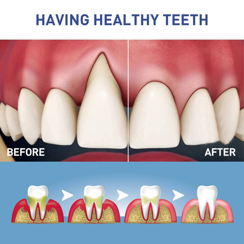 West&Month 牙龈护理凝胶 清洁牙斑污渍缓解牙龈退缩肿痛焕白牙齿