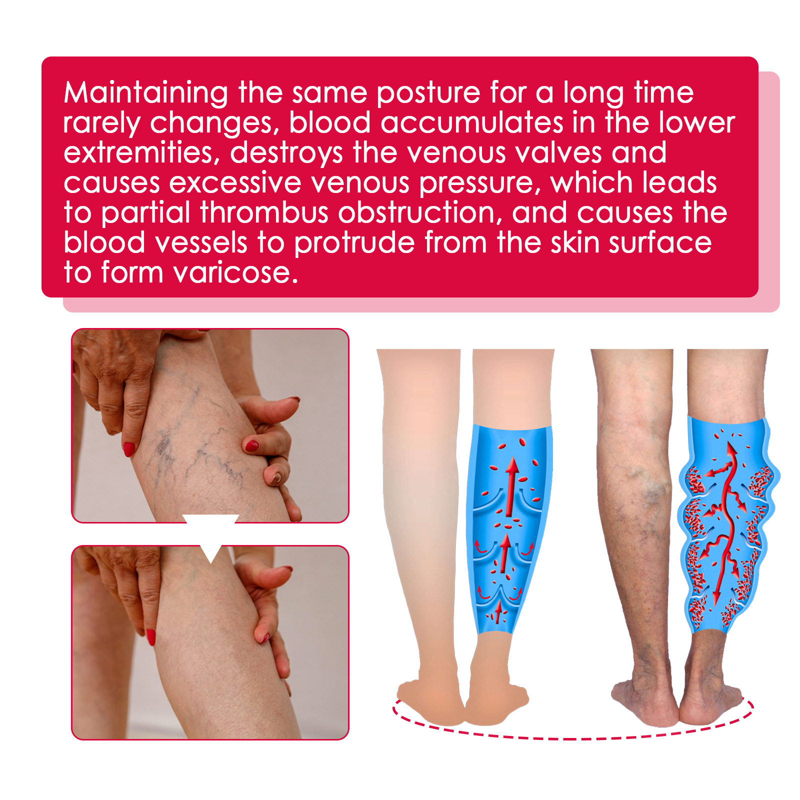 EELHOE Rose Venenpflege Ätherisches Öl Beinmassage Krampfadern Verbesserung der Durchblutung Lymphdrainage Beinpflege_voghion.com