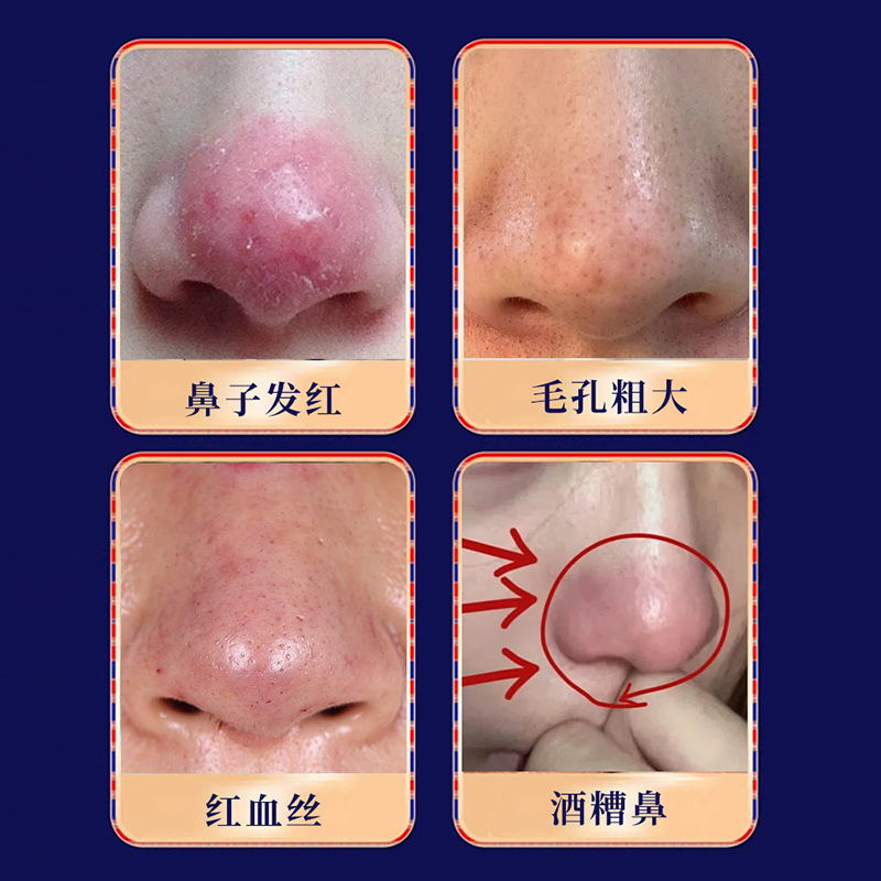 藏北荒药业酒糟鼻膏 鼻子发红毛孔粗大红血丝不适草本外用护理膏|undefined