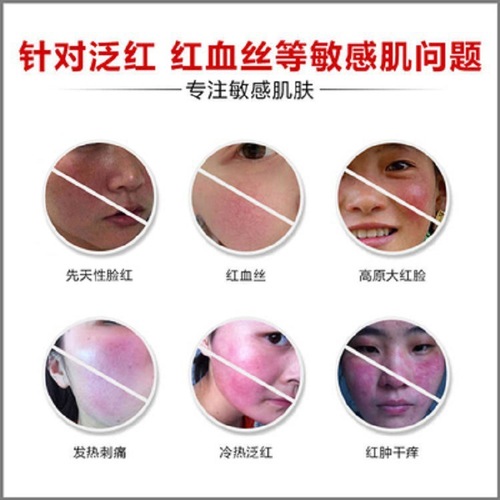 Sensitive Skin Repair Cream Centella Asiatica Essence Soothing Redness Thickening Stratum Corneum Beauty Salon Redness Reduction Face Cream