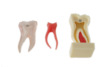 Teaching model removable oral repair model pathological dental model activity tooth model planting model