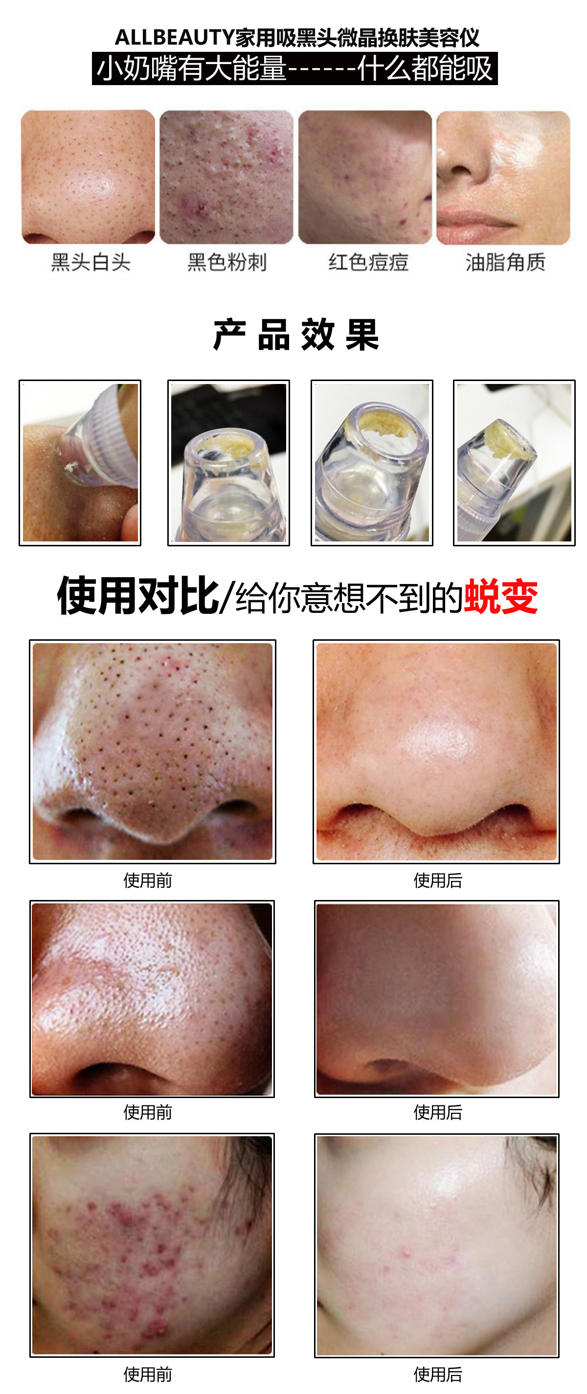 奥皮特EMS吸黑头仪器 微晶磨皮焕肤仪 面部微雕美容粉刺毛孔