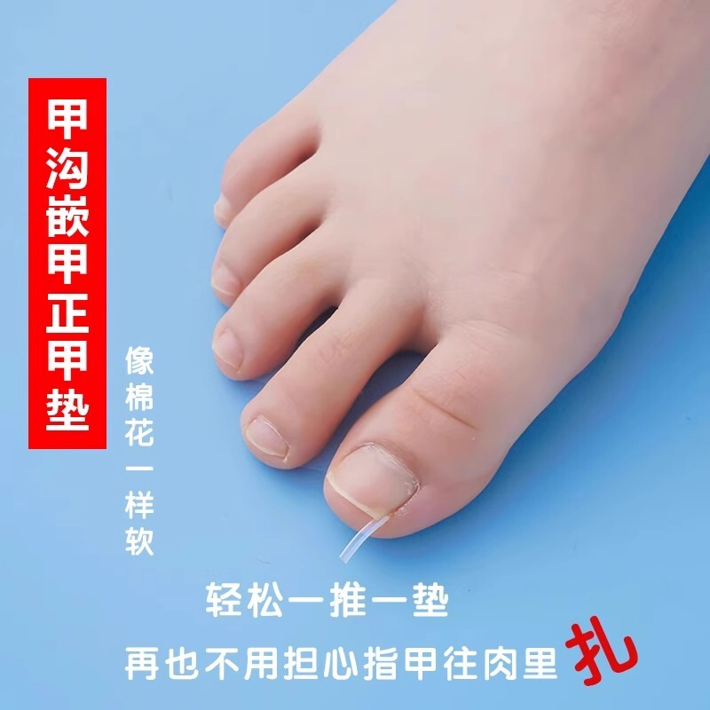 Toenail straightener nail sticking nail patch inlay toenails into the meat long correction isolation padding