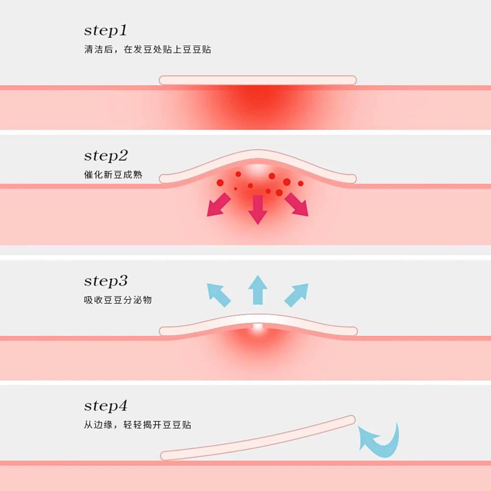 Pimple Patch Hydrocolloid Acne Patch, Transparent Makeup‑Friendly, Various Counts (1–200 pcs)