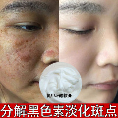 そばかす、肝斑、シミを除去するトラネキサム酸クリーム、メラニンを抑制するトラネキサム酸、美白・シミ除去クリーム