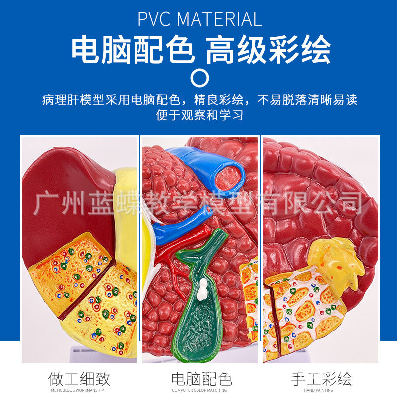 ��ɫ����ģ�ͳ����ٴ���������ҽ����ҽ����ͨӲ��֬���׸ε��ڿ�