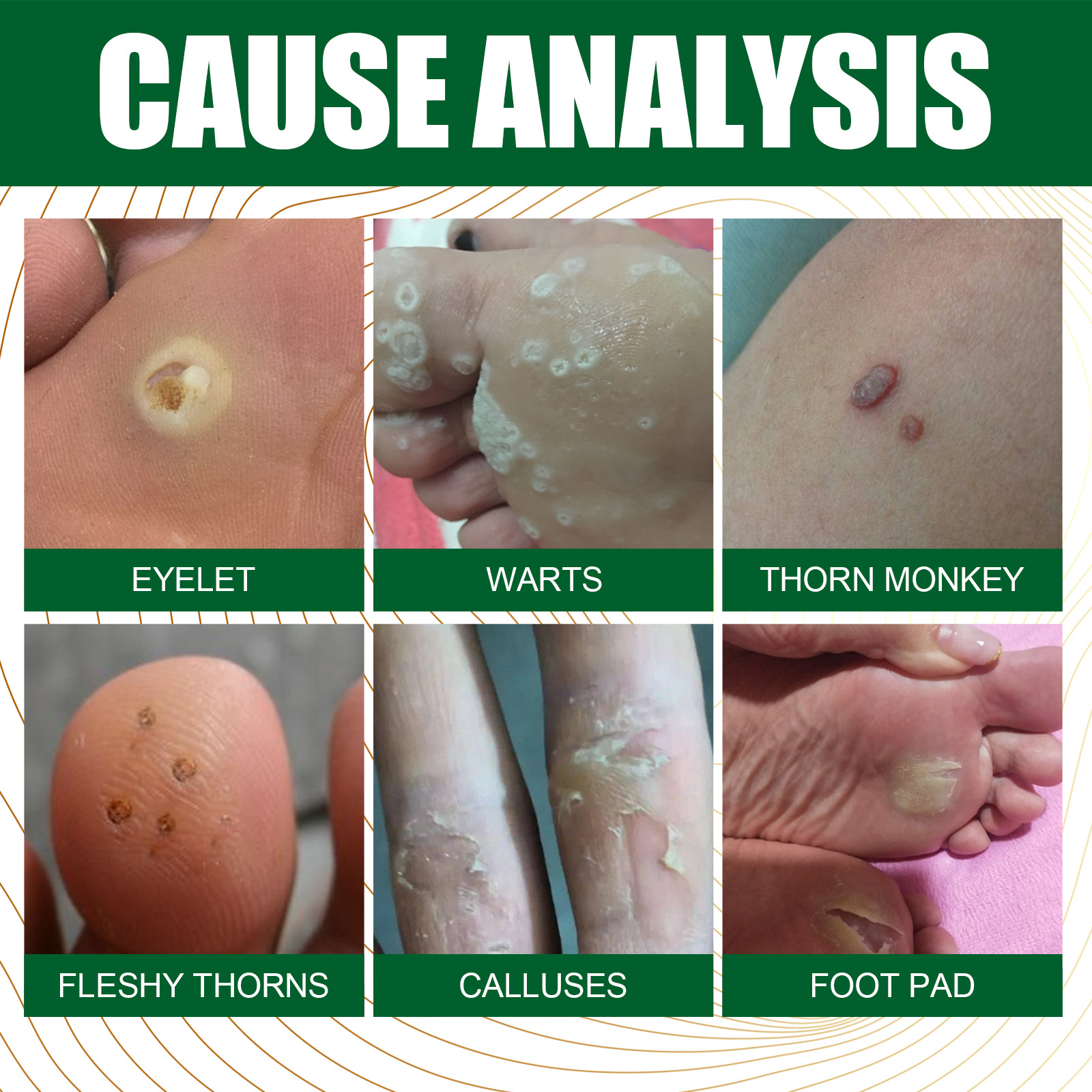 2024 wart remover to lighten flesh thorns, flat skin, especially corns, body warts, and filamentous warts_voghion.com