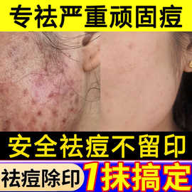 草本祛痘膏淡化青春痘修护痘印痘坑粉刺闭口控油男女可用美容院
