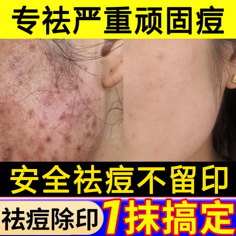 草本祛痘膏淡化青春痘修护痘印痘坑粉刺闭口控油男女可用美容院