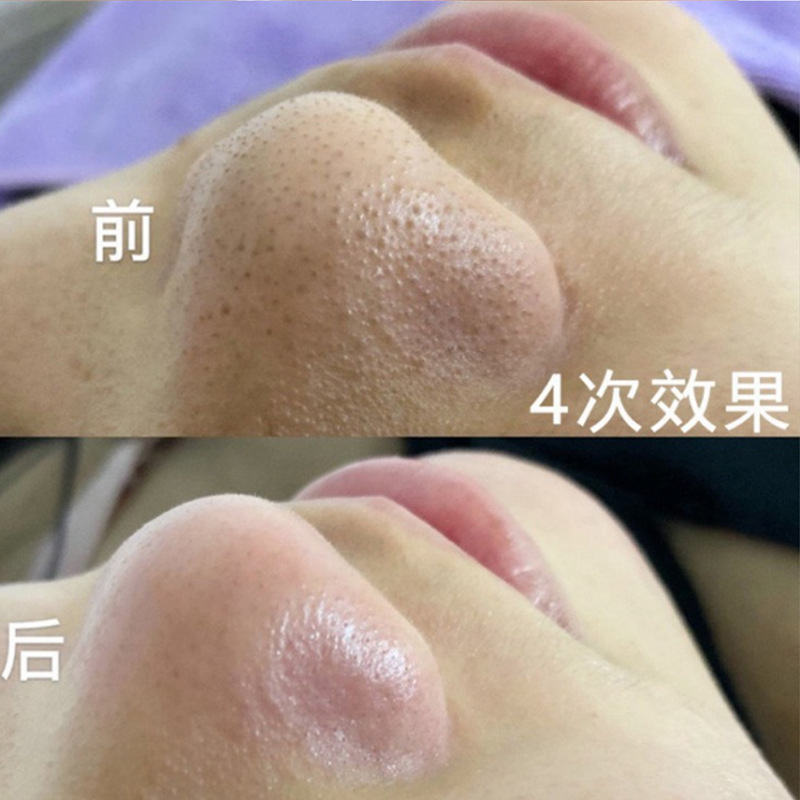 毛孔清洁净化霜美容院面部深层清洁按摩膏毛囊清洁术去闭口黑头乳|undefined