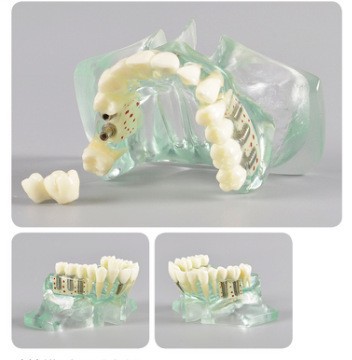 Modelo de ortodoncia dental semi-metal semibrackets Práctica de corrección de molde dental estándar Comunicación médico-paciente Modelo de enseñanza Modelo dental