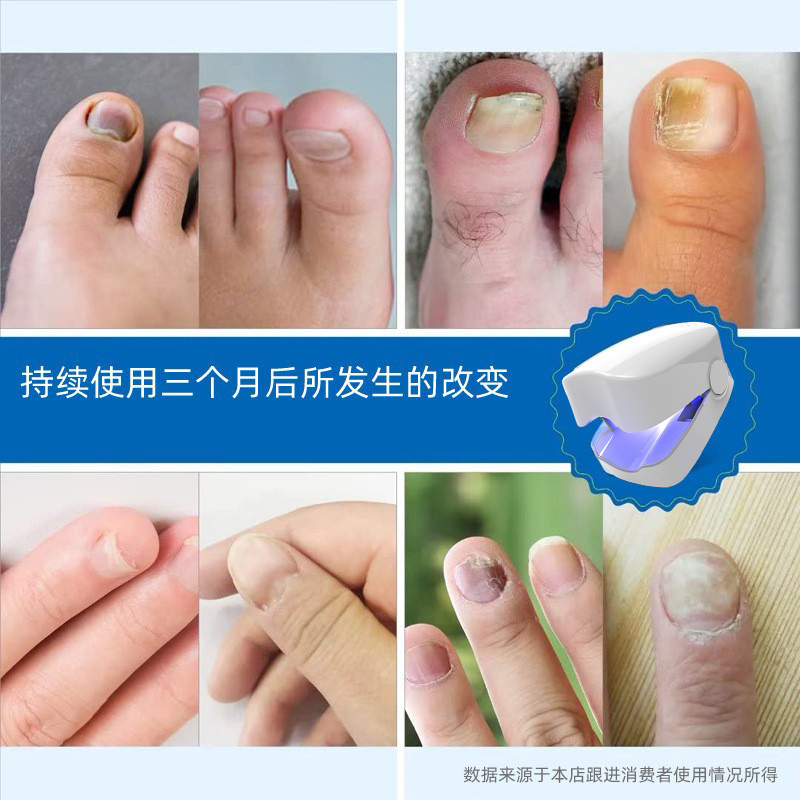越境爪光線治療器灰爪補助ツール紫外線爪光線治療灯クリーンランプ真菌灯ネイル|undefined