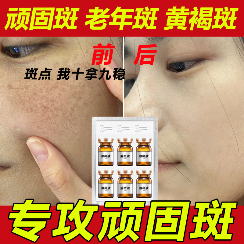 Non-invasive spot dissolving liquid non-peeling spot removing liquid to remove chloasma, senile spots, freckles, melanin decomposition and spot removing essence