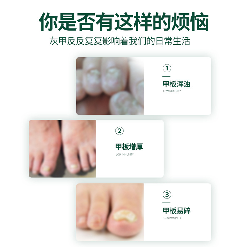 Nanjing Tong Ren Tang Jia Jing Liquid for Removing Onion Finger Nails, Special Nail Repair Soft Nail Liquid, Herbal Foot Care Onion Nail Liquid