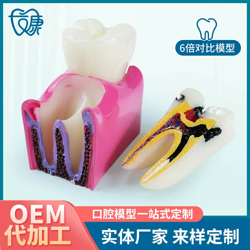 6倍对比模型牙科教学器材6倍龋齿对比模型口腔模型教学牙齿模型