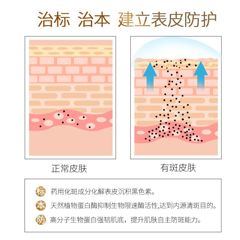 ハーブ美白そばかすクリームセット、シミ除去強化版そばかすクリーム、強力な黒いそばかす除去クリーム|undefined