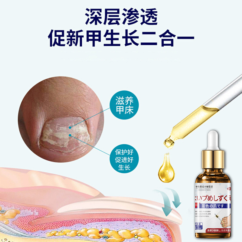 日本正規品の爪真菌症専用健康液、家庭用で頑固な爪の軟化・剥離・美白に効果的、最低注文数1個|undefined