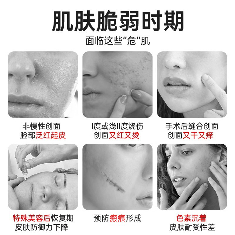 法兰度医用重组III型人源化胶原蛋白凝胶烧烫伤创面术后创面擦伤|undefined