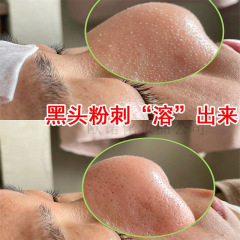 黒頭導出液は温和に黒頭白頭にきびに行きます。口を閉じて清潔にします。毛穴美容院の黒頭導出液です。