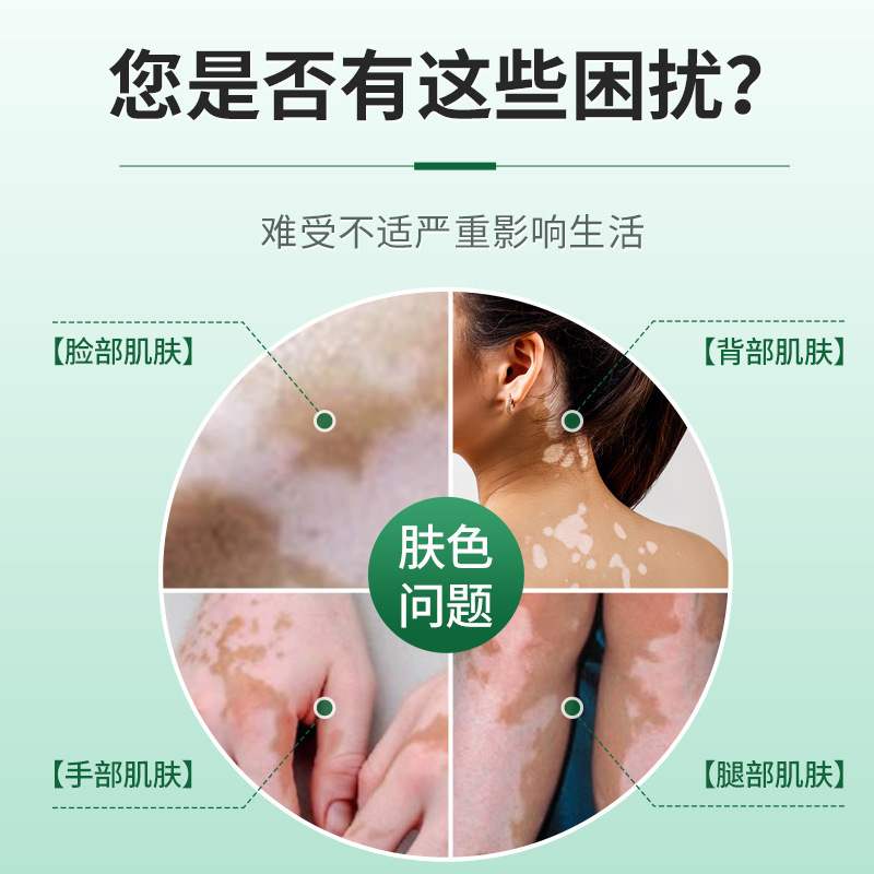 Chuanhong Palace 白斑軟膏局所メラニン成長サプリメント軟膏特別な急速白斑除去カバー液|undefined