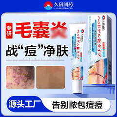Jiuyan Pharmaceutical マラセチアヘッド毛包軟膏特別な赤いニキビ頭皮かゆみロングヘッドニキビ毛包軟膏