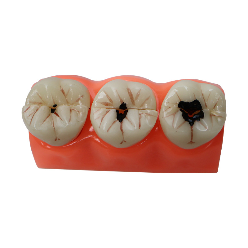 Descomposición de caries dental modelo anatomía modelo dientes cuidado dental caries dental