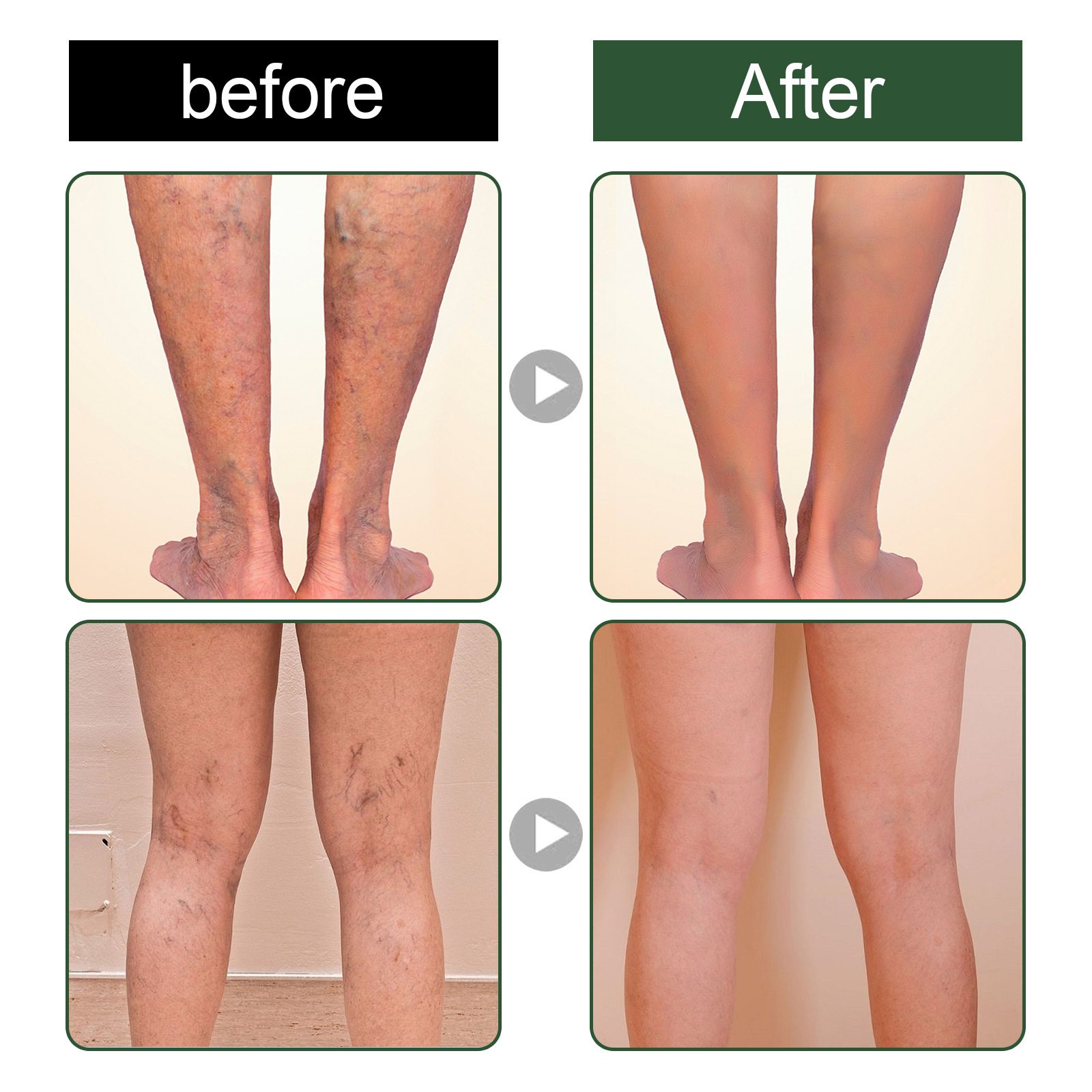 Massaggio endovenoso Eelhoe con sapone per lenire le varici, alleviare le sporgenze nelle gambe dei lombrichi e pulire il polso_voghion.com