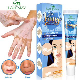 Cross-border White Spot Removal Cream White Spot Care and Health Care Cream White Spot Net Cream White Spot Sweat Spot White Purpura Skin External Application Cream