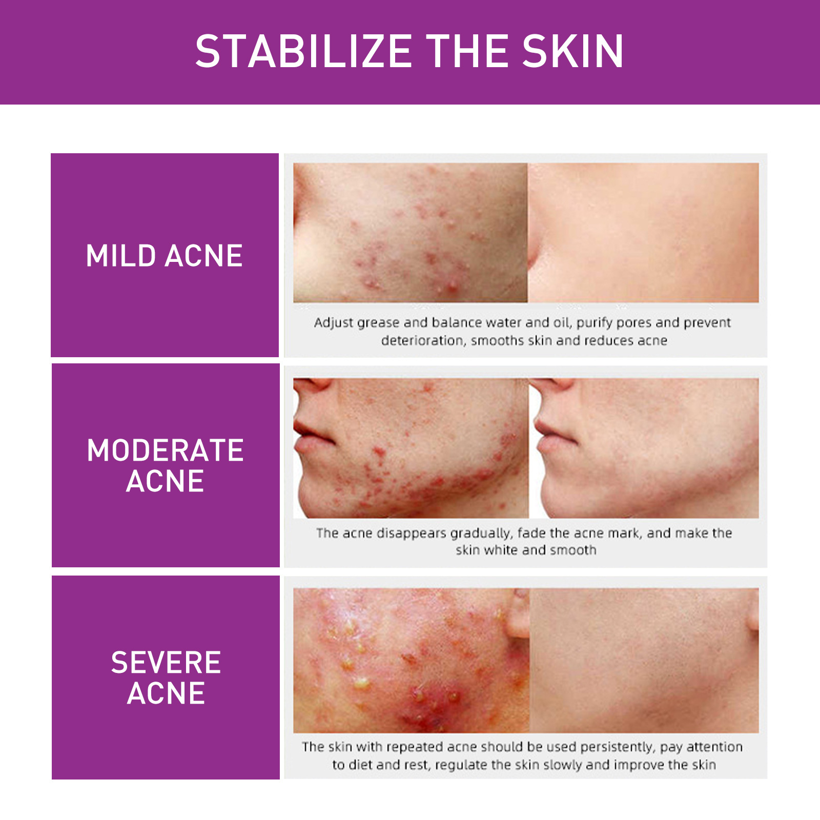 EELHOE Spot Lightening Whitening Cream mindert Akneflecken, repariert dunkle Flecken, spendet Feuchtigkeit, festigt und verbessert die Haut_voghion.com