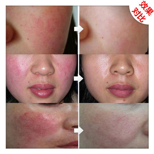 Hormone face repair cream improves sensitive skin repair, reduces redness, removes redness, acne scars, beauty salon live cell repair cream