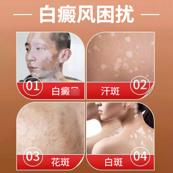 Thailand Reclining Buddha Vitiligo Crazy Ointment Cream White Spot Special Psoralea Tincture External Use Melanin Growth Factory Direct Camp