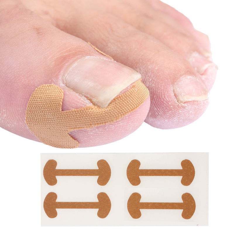 Toenail correction patch, ingrown nail correction patch, simple nail correction patch for ingrown nails that dig into the flesh Toenail correction patch, ingrown nail correction patch, simple nail correction patch for ingrown nails that dig into the flesh
