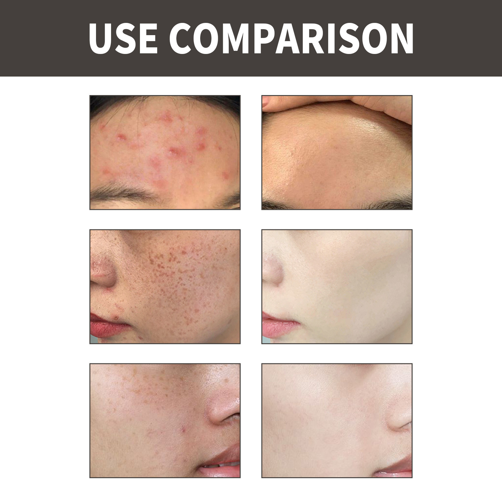 OUHOE Dark Spot&Acne för att bleka fläckar, återfukta huden, reparera aknemärken, mörka och ljusa upp ansiktets essens_voghion.com