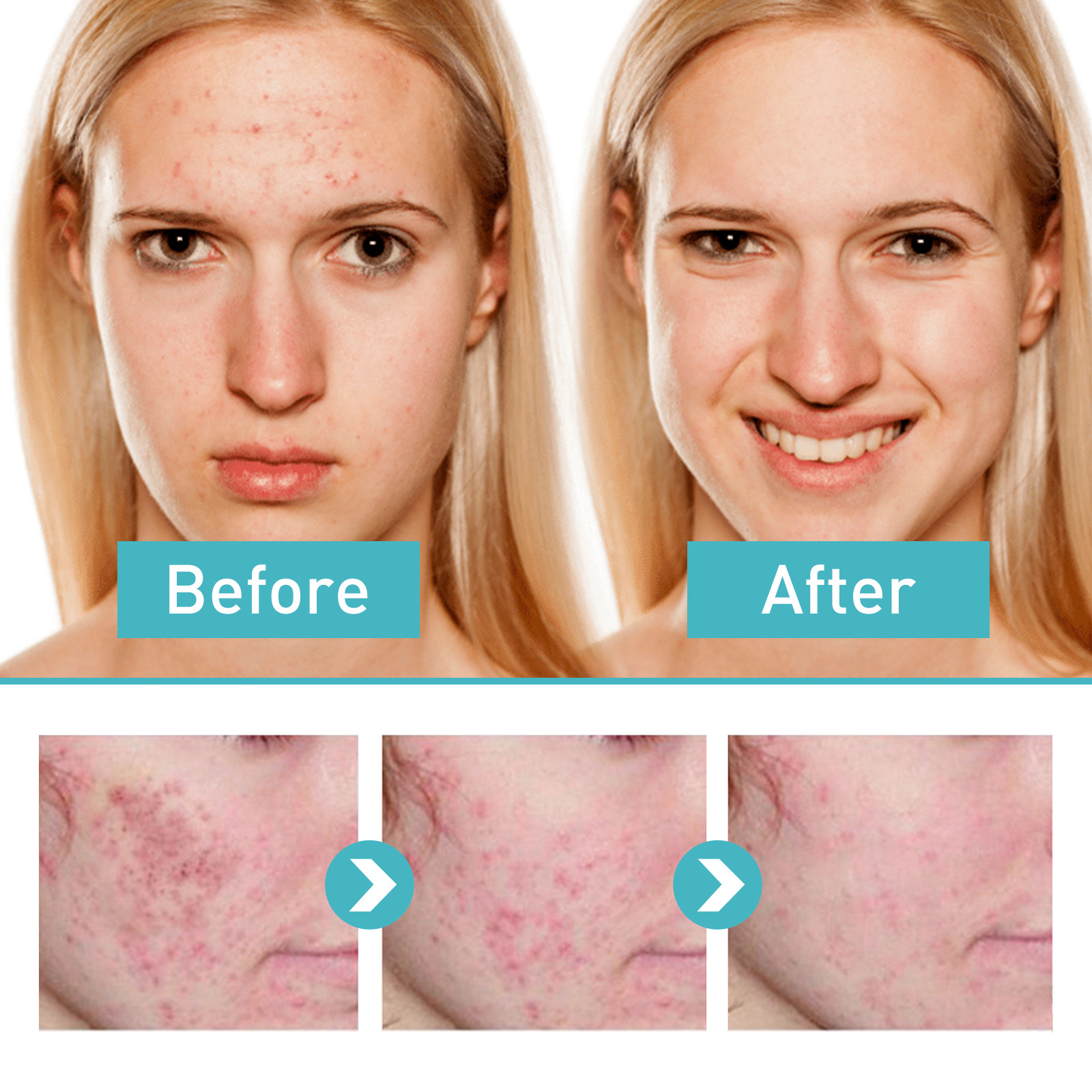 Il gel riparatore Jayusing schiarisce i segni, le macchie dell'acne, ripara, idrata e illumina la pelle_voghion.com