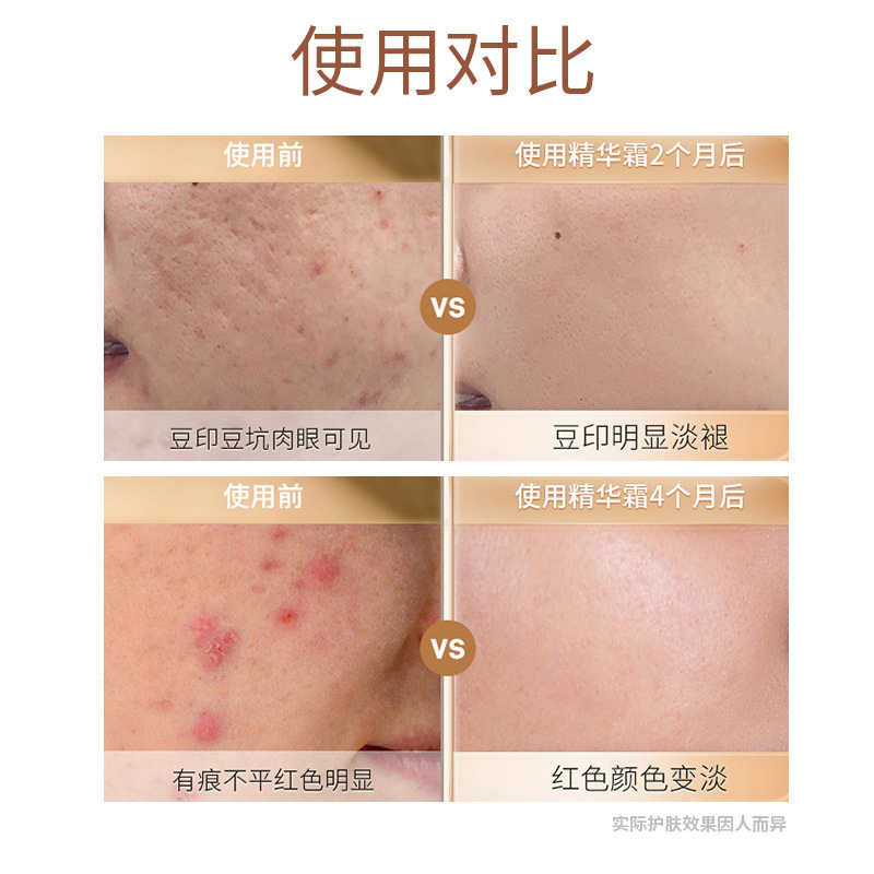 Zhenshy Skin Smoothing Repair Cream Herbal Cleansing Stretch Marks Diminishing Acne Marks and Gently Diminishes Fine Lines and Marks