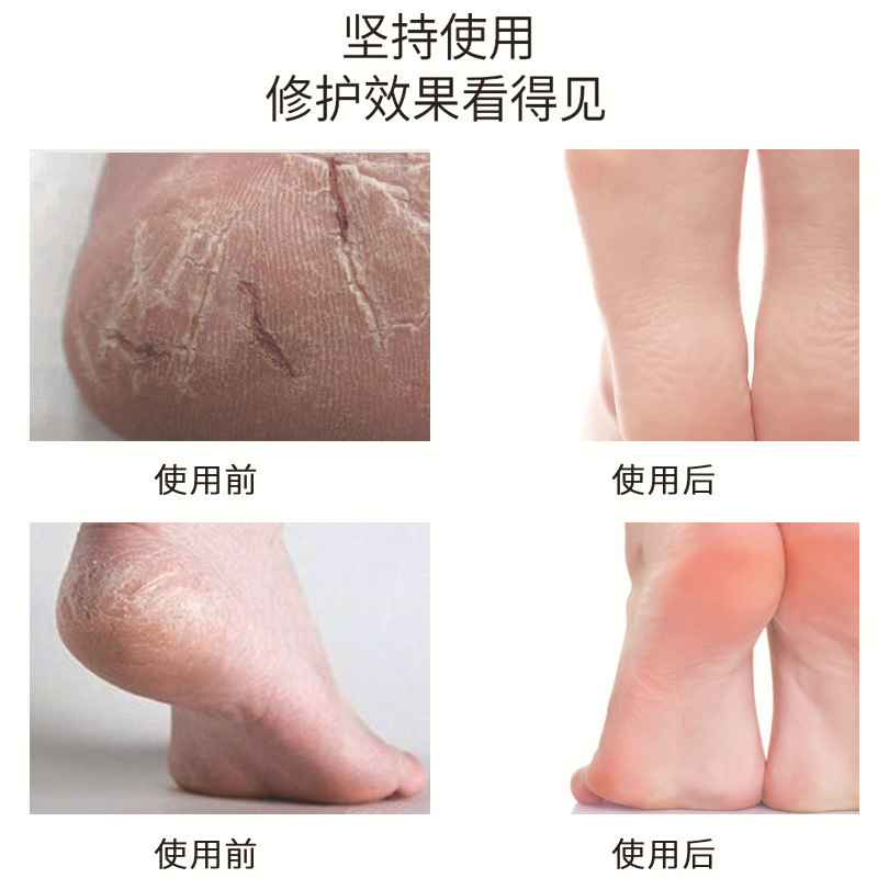 Exfoliante de pies de manteca de karité, gel exfoliante para pies, exfoliante corporal para pies