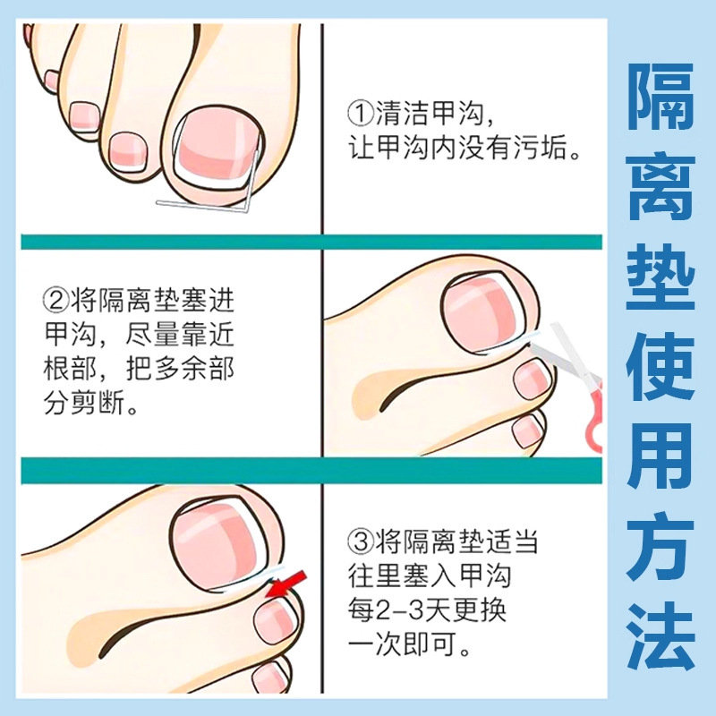 甲沟矫正神器指甲嵌甲专用隔离填充垫片脚趾甲往肉里长纠正甲贴|undefined