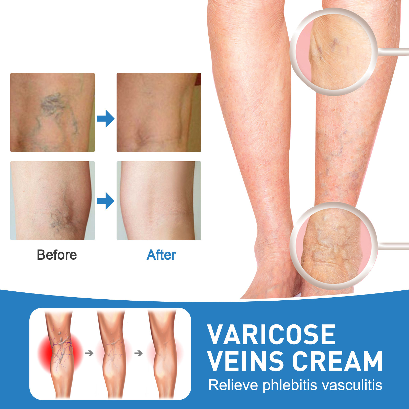EELHOE Repair-masaje calmante de venas venosas, alivio de varices, crema para el dolor abultado Vascular de las piernas_voghion.com