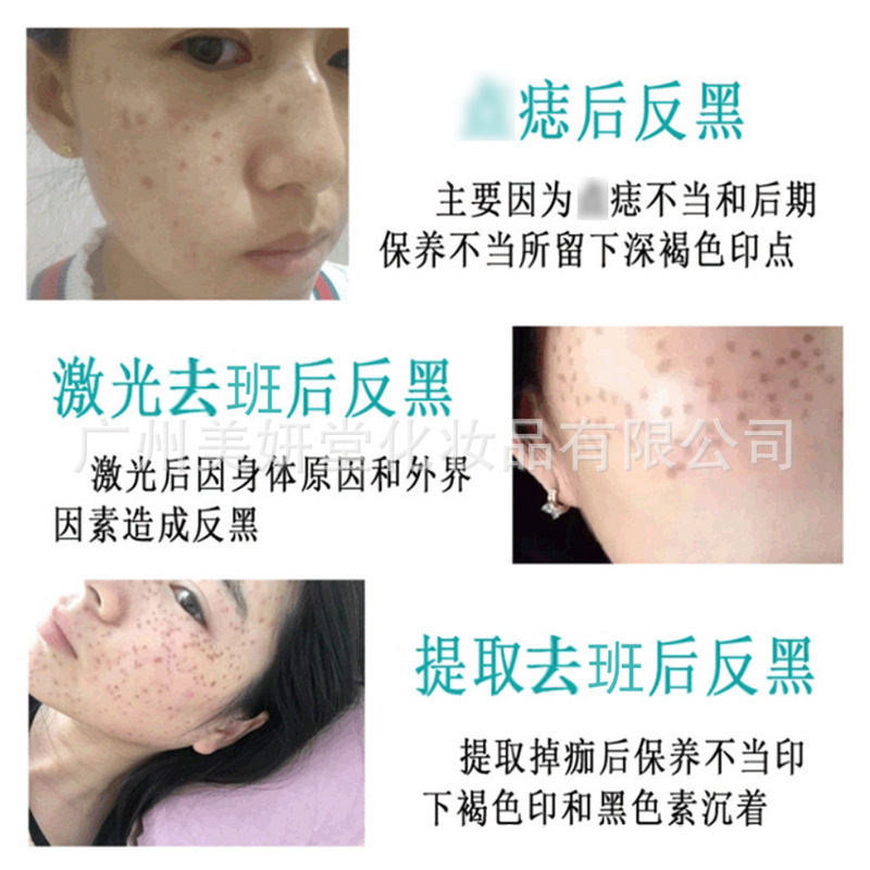 美容院控色霜焕颜霜抑制色素回流皮秒激光提取术后防反黑抽色绿霜|undefined