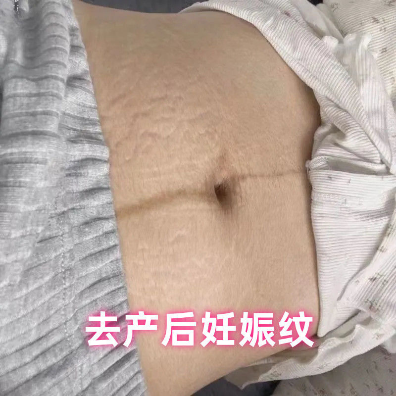 妊娠の紋様の修復クリームは薄い紋様を引き締めて太っている紋様を取り除きます。|undefined