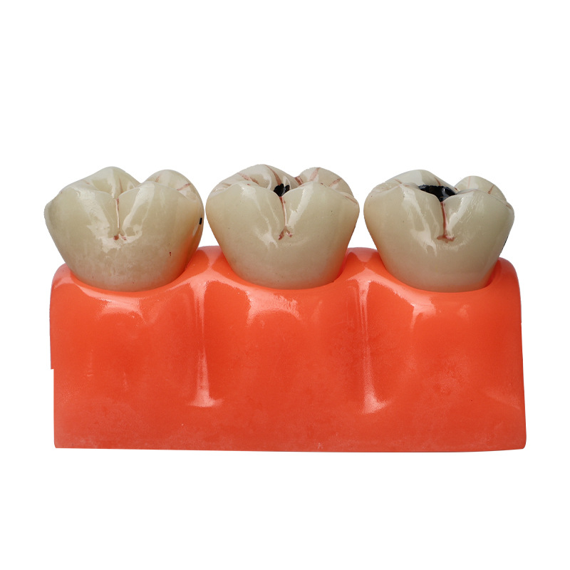 Descomposición de caries dental modelo anatomía modelo dientes cuidado dental caries dental