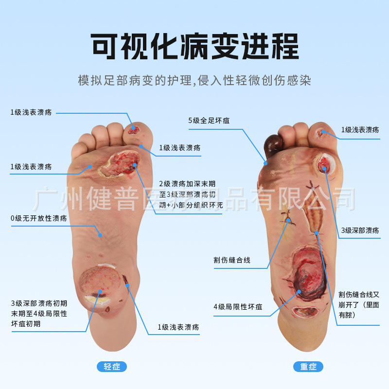 Teaching Explanation Model, Diabetic Foot Model, Mild Diabetic Foot Model, Severe Diabetic Foot Model, Foot Care