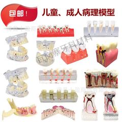 歯科口腔教育モデル虫歯虫歯不良発展デモ水晶成人病理モデル歯解剖展示