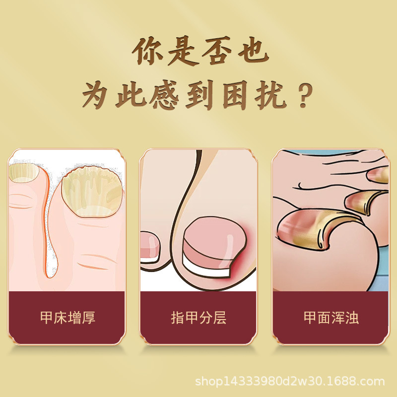 非物质文化遗产豫方祖灰指甲保健膏灰甲坏甲适宜于灰指甲甲沟不适|undefined