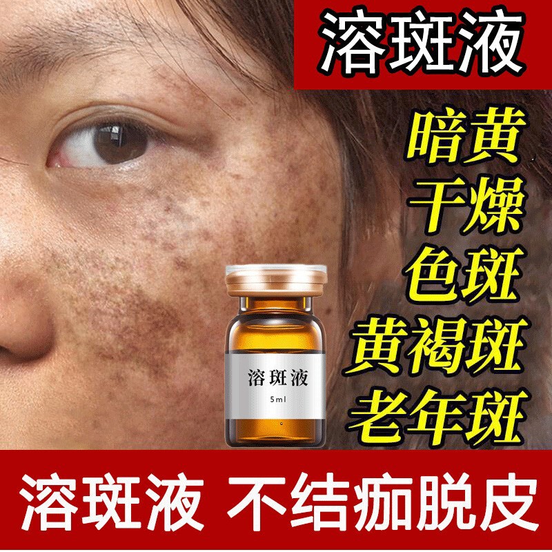 Freckle Removal Liquid, Whitening and Freckle Removal Solution, Non-Invasive Freckle Removal Liquid, Non-Peeling Solution for Removing Chloasma and Freckles, Freckle Removal Essence