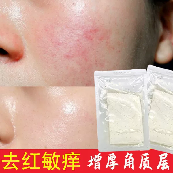 Hydrating and Repairing Mask for Sensitive Skin, Beauty Salon Laser Post-Treatment Redness and Itching Hormone Face Thickening and Cuticle Repair Mask