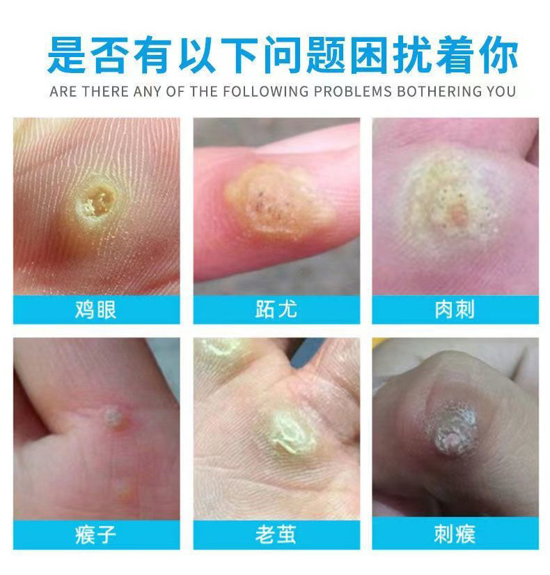 南京同仁堂绿金家园鸡尤康瘊子鸡茧膏肉刺瘊尤跖疣老茧贴鸡眼贴-阿里巴巴