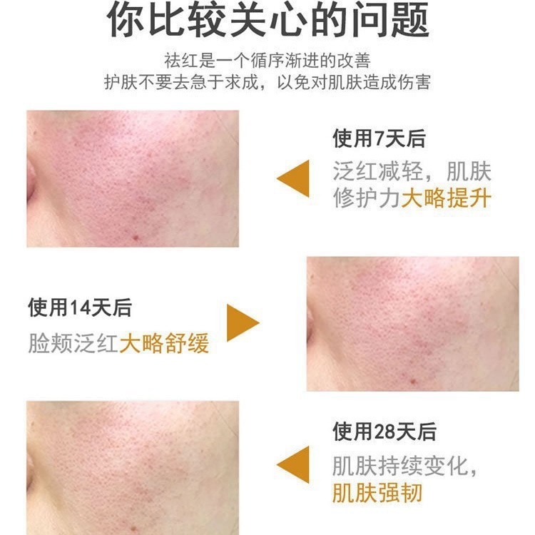 センテラ アジアティカ リペア クリーム 敏感肌を改善し、赤みを修復し、赤みを取り除き、ニキビ跡を除去します ビューティー サロン ライブ セル リペア クリーム|undefined
